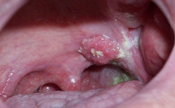 phân biệt viêm họng và ung thư vòm họng