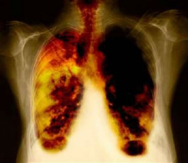 Bệnh bụi phổi silic