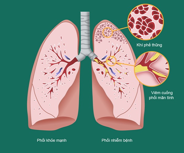 Bệnh phổi tắc nghẽn mãn tính COPD