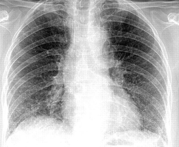 Hình ảnh X - quang viêm phổi