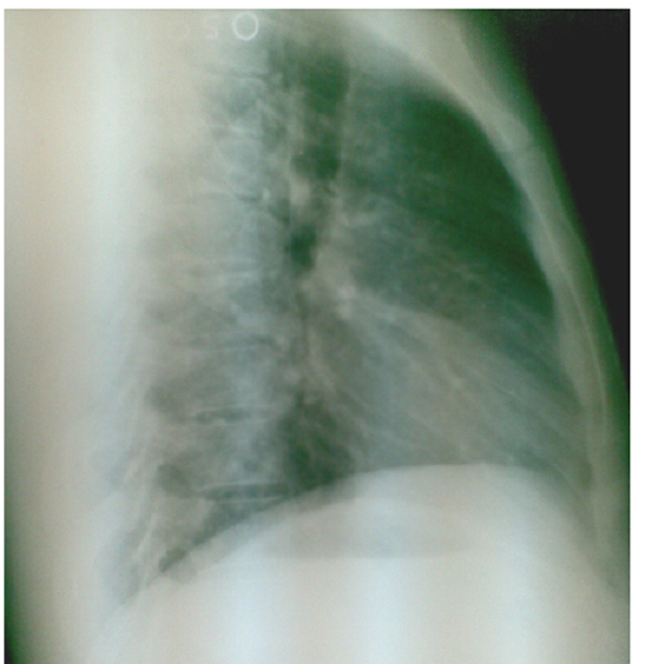 X-quang phổi bình thường