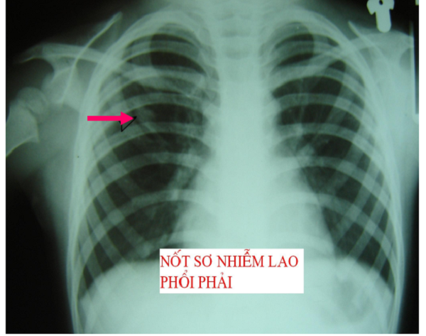 X-quang lao phổi