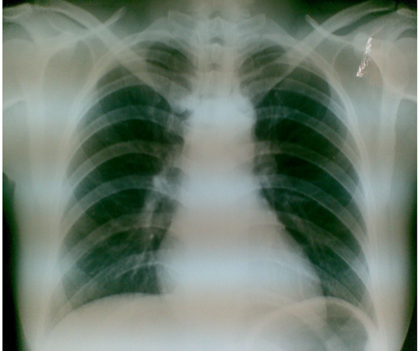 X-quang phổi
