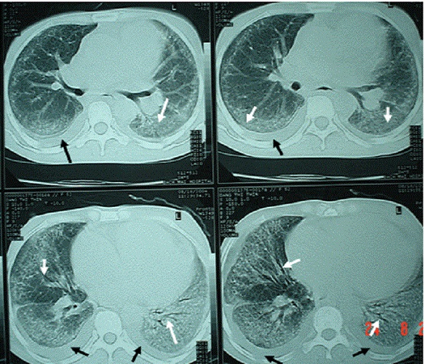 Chụp CT phổi