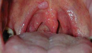 Hình ảnh viêm họng do virus