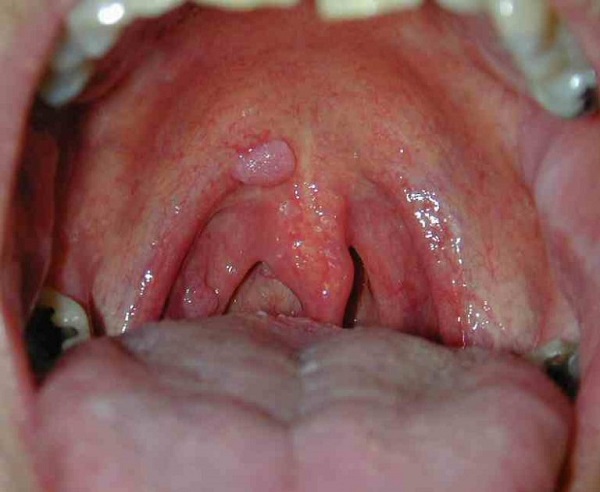 Hình ảnh ung thư vòm họng