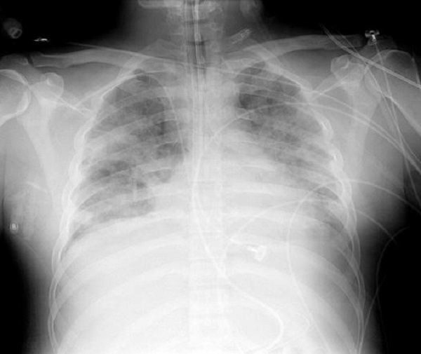 Hình ảnh X-quang ngực người bệnh ARDS