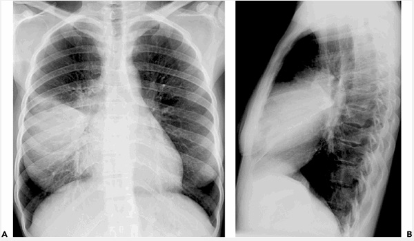 Hội chứng đông đặc phổi nguyên nhân, triệu chứng nhận biết - Kênh iTV