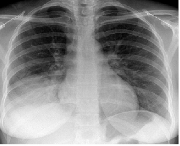 Hội chứng đông đặc phổi