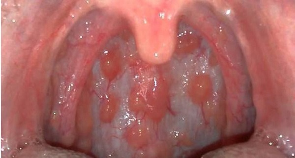 hình ảnh viêm họng hạt