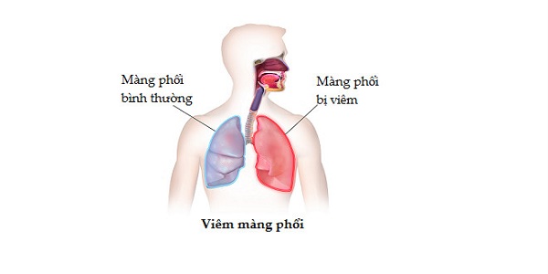 Viêm màng phổi