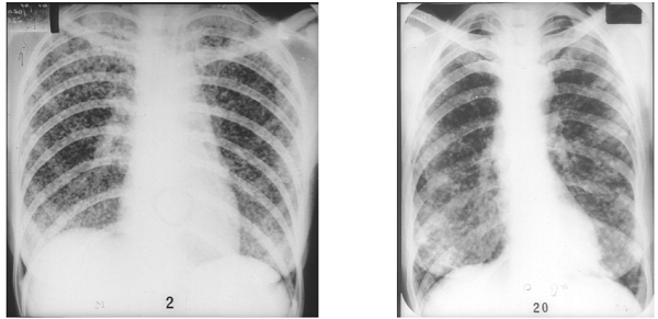 X-quang lao phổi