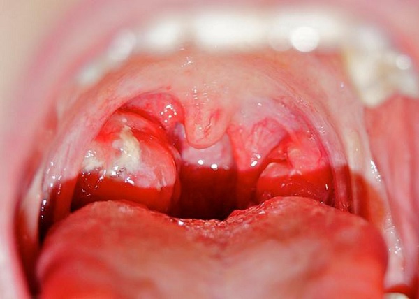 Viêm họng có thể gây rát lưỡi đau họng