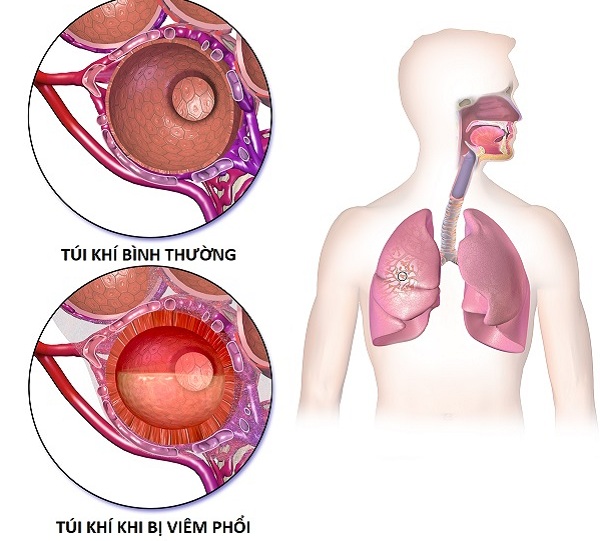 Viêm phổi cấp là gì?