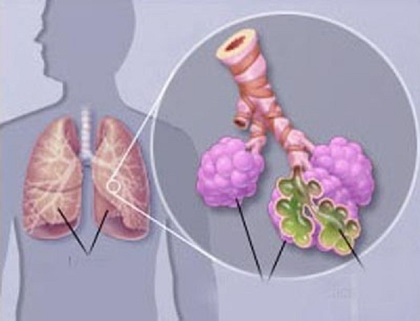 Viêm phổi phế cầu khuẩn là gì? Triệu chứng, điều trị và phòng ngừa
