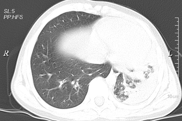 Hình ảnh CT scan viêm phổi mycoplasma