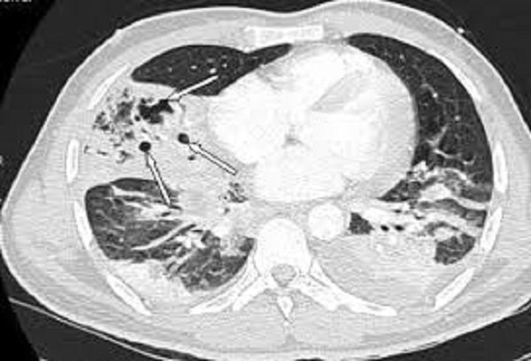 Hình ảnh CT scan viêm phổi tụ cầu
