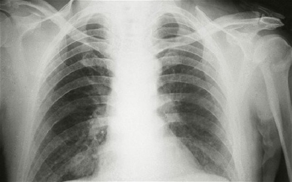 Hình ảnh X-quang viêm phổi do virus